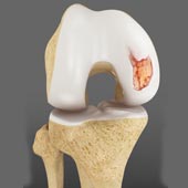 Knee Cartilage Defects