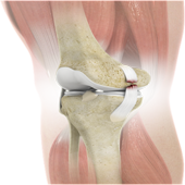 Knee Ligament Injuries