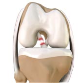 ACL Rupture