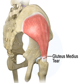 Gluteus Medius Tears