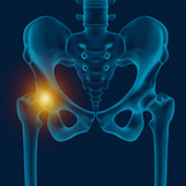 Treatment For Hip Bursitis and Causes Melbourne