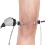 Arthroscopy of the Knee