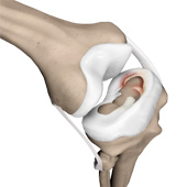 Knee Meniscus Tears