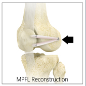 MPFL Reconstruction