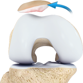 Patella Instability & Dislocations