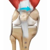 Patella stabilisation