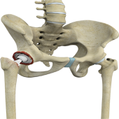 Revision Hip Replacement Surgery