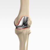 Revision Knee Replacement Surgery