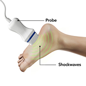 Shockwave Therapy