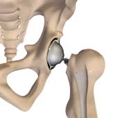 Hip Replacement Surgery